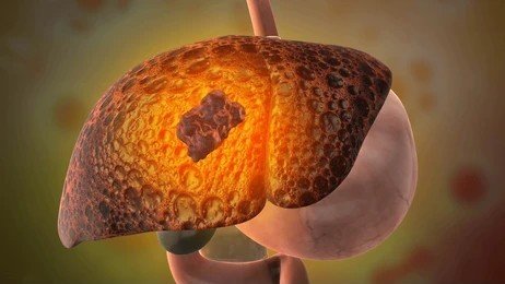 Liver Cancer